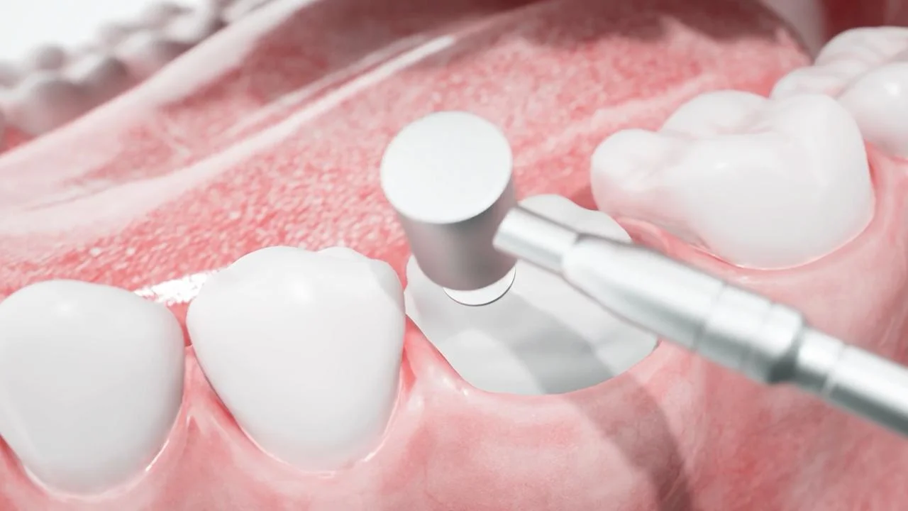 Composite Bonding Operation