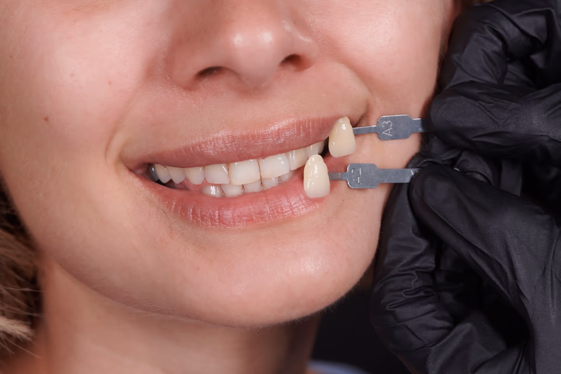 Ihr Weg zu einem neuen Lächeln mit Veneers