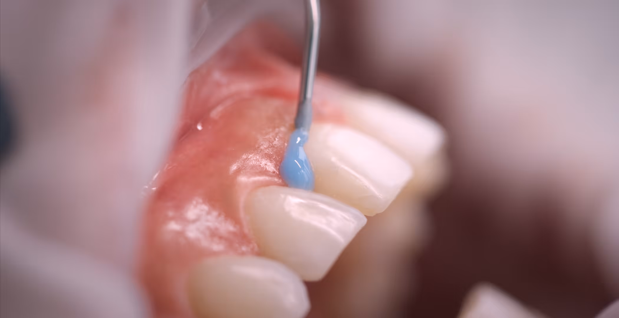 Glückliche Patientin nach Bleaching-Behandlung