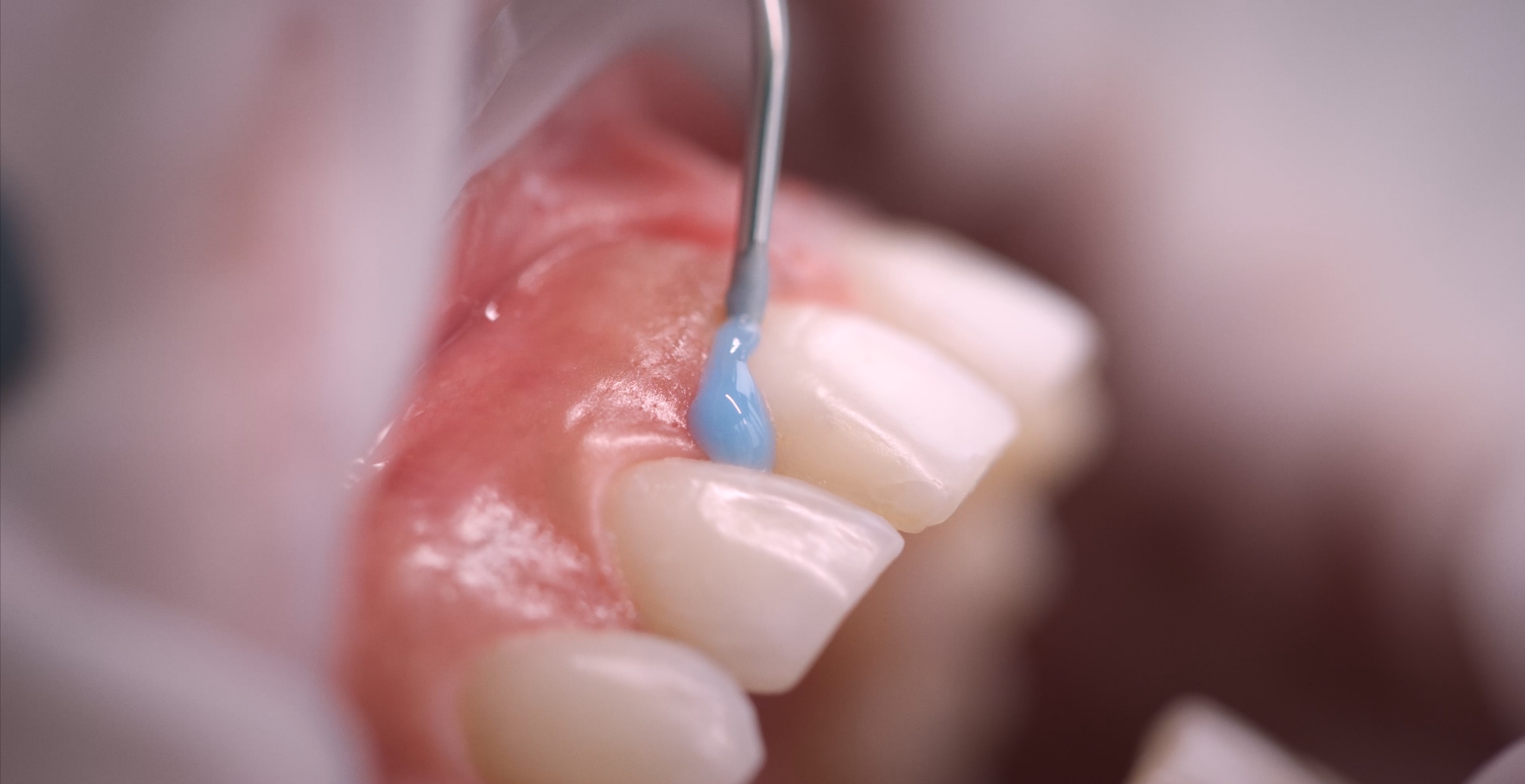 Glückliche Patientin nach Bleaching-Behandlung