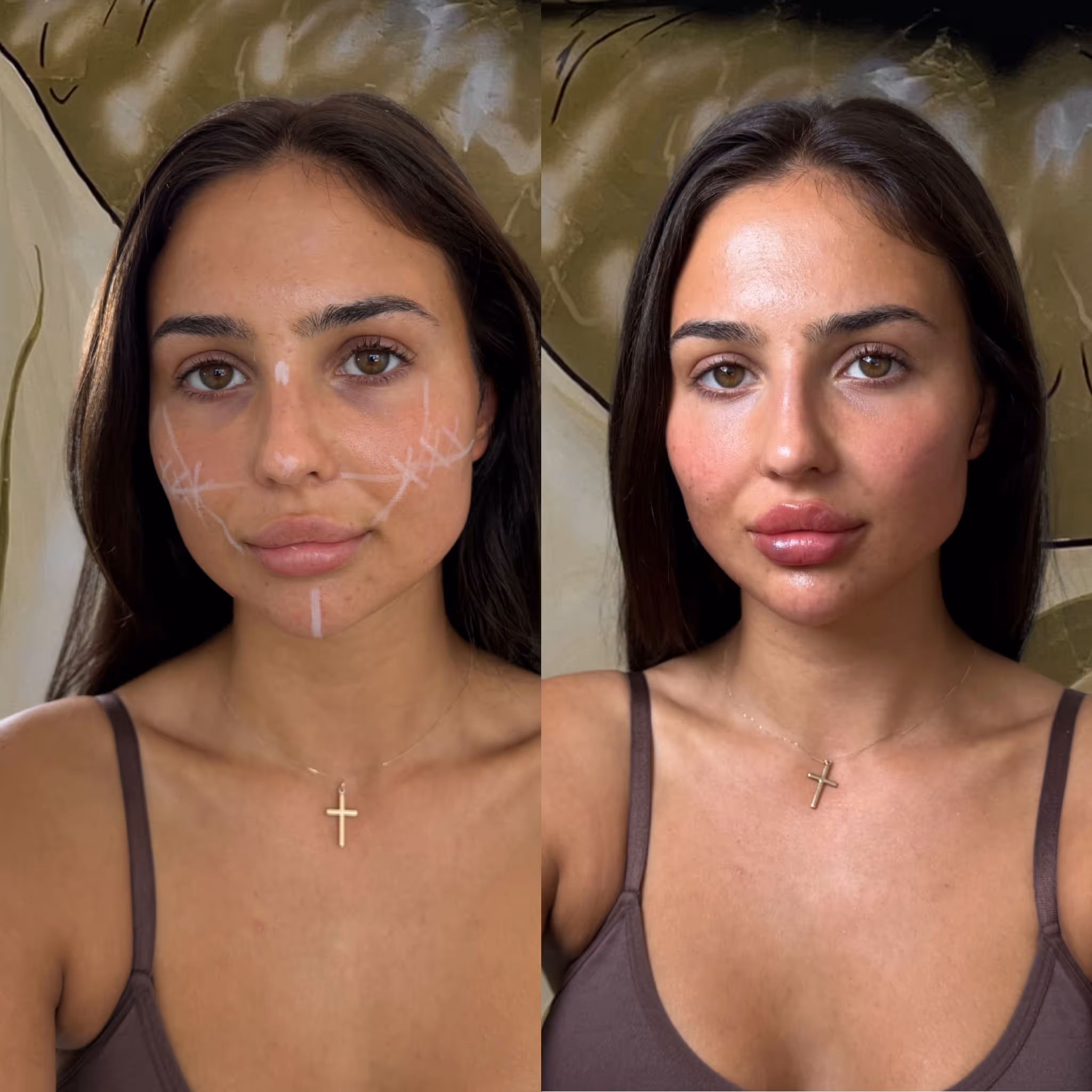 Before and after Botox results at CA Clinic Dubai