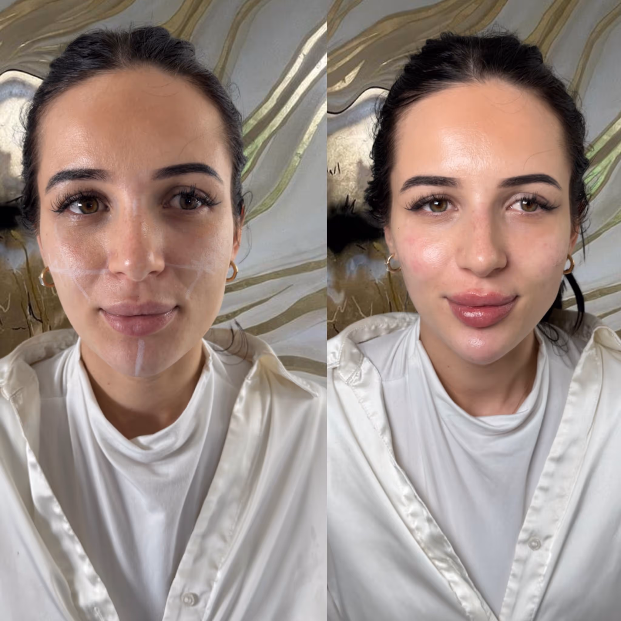 Before and after Botox results at CA Clinic Dubai