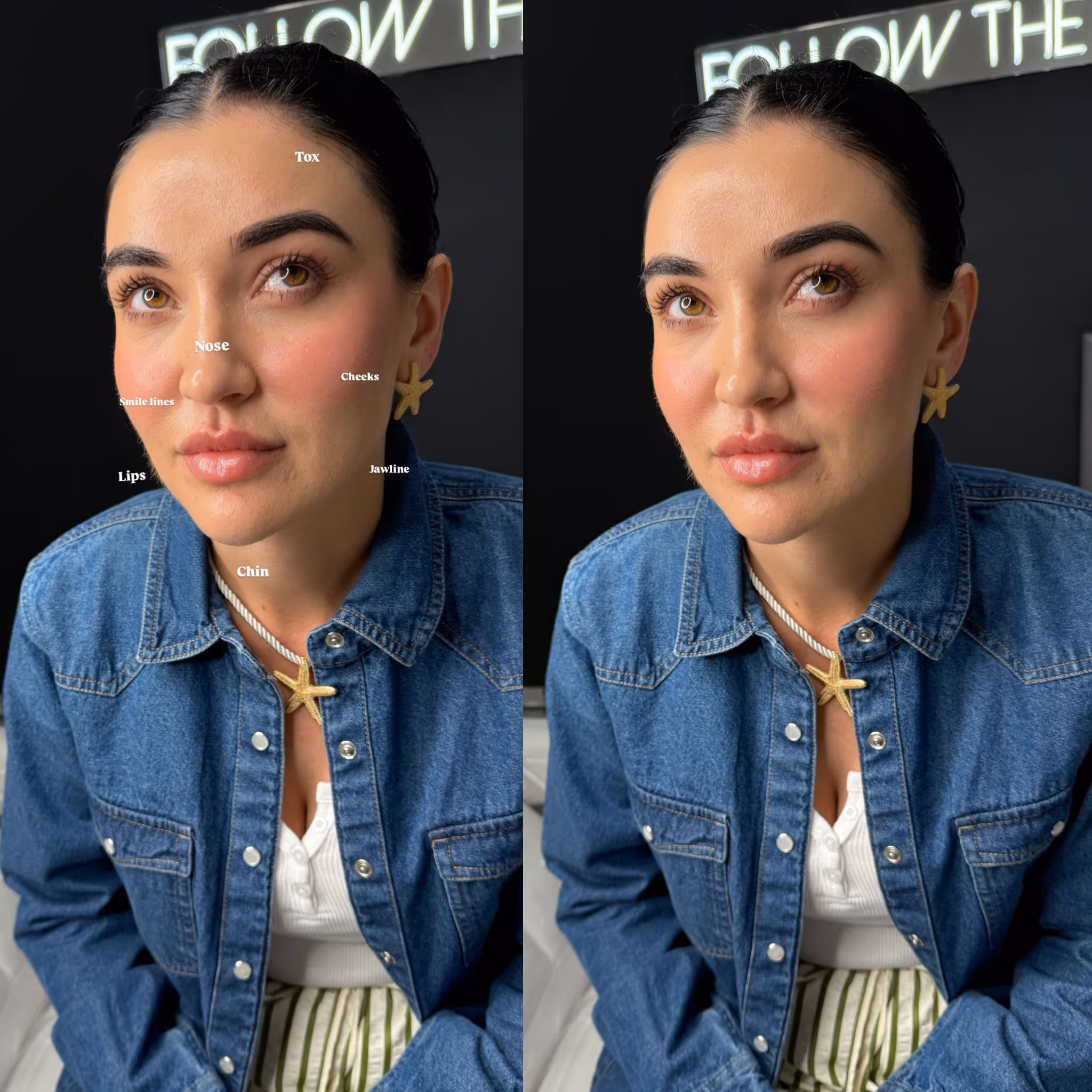 Before and after botox results at CA Clinic Dubai