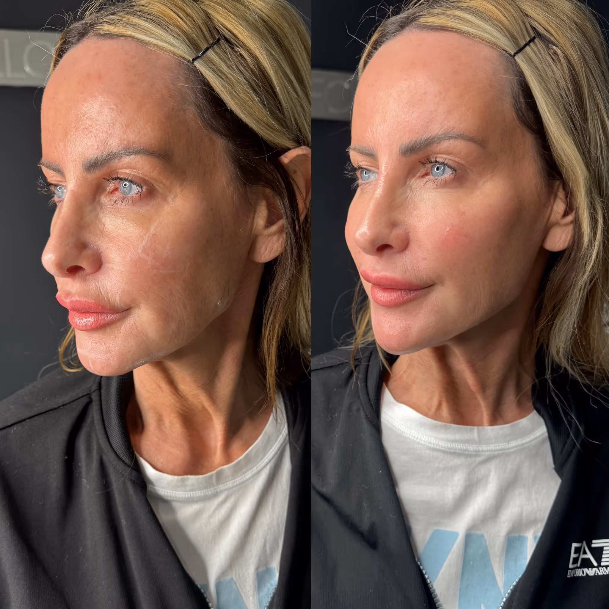 Before and after botox results at CA Clinic Dubai
