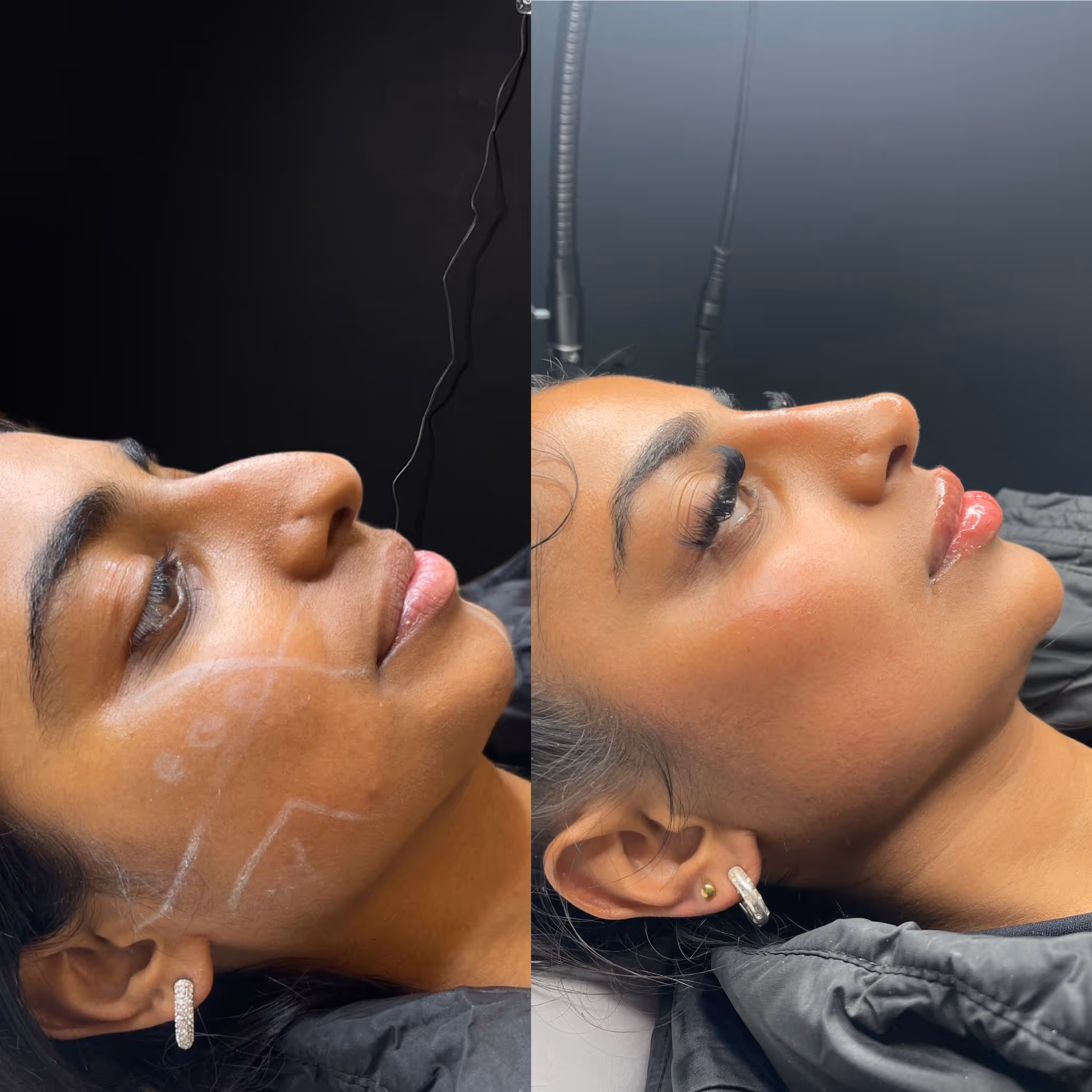 Before and after Botox results at CA Clinic Dubai