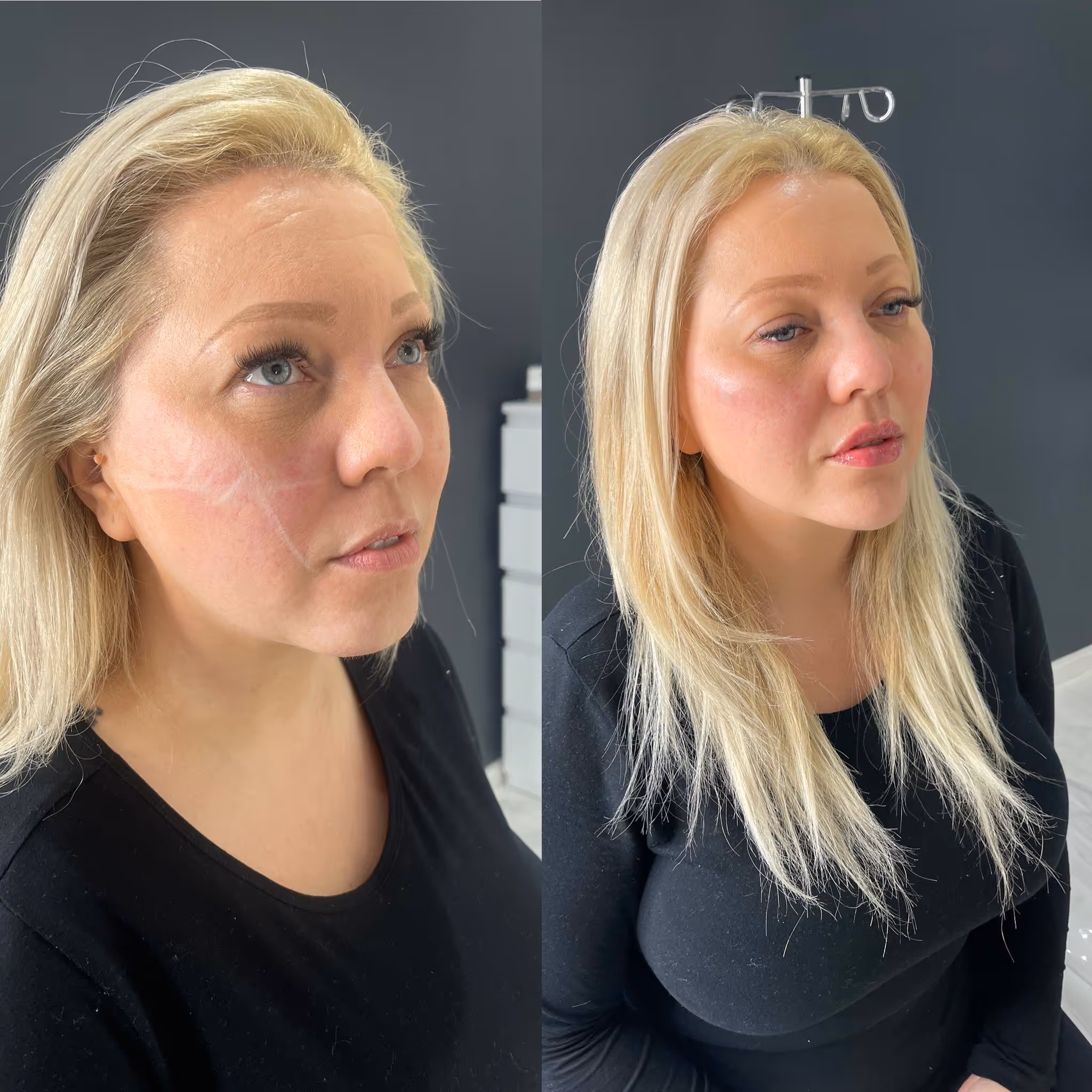 Before and after Botox results at CA Clinic Dubai