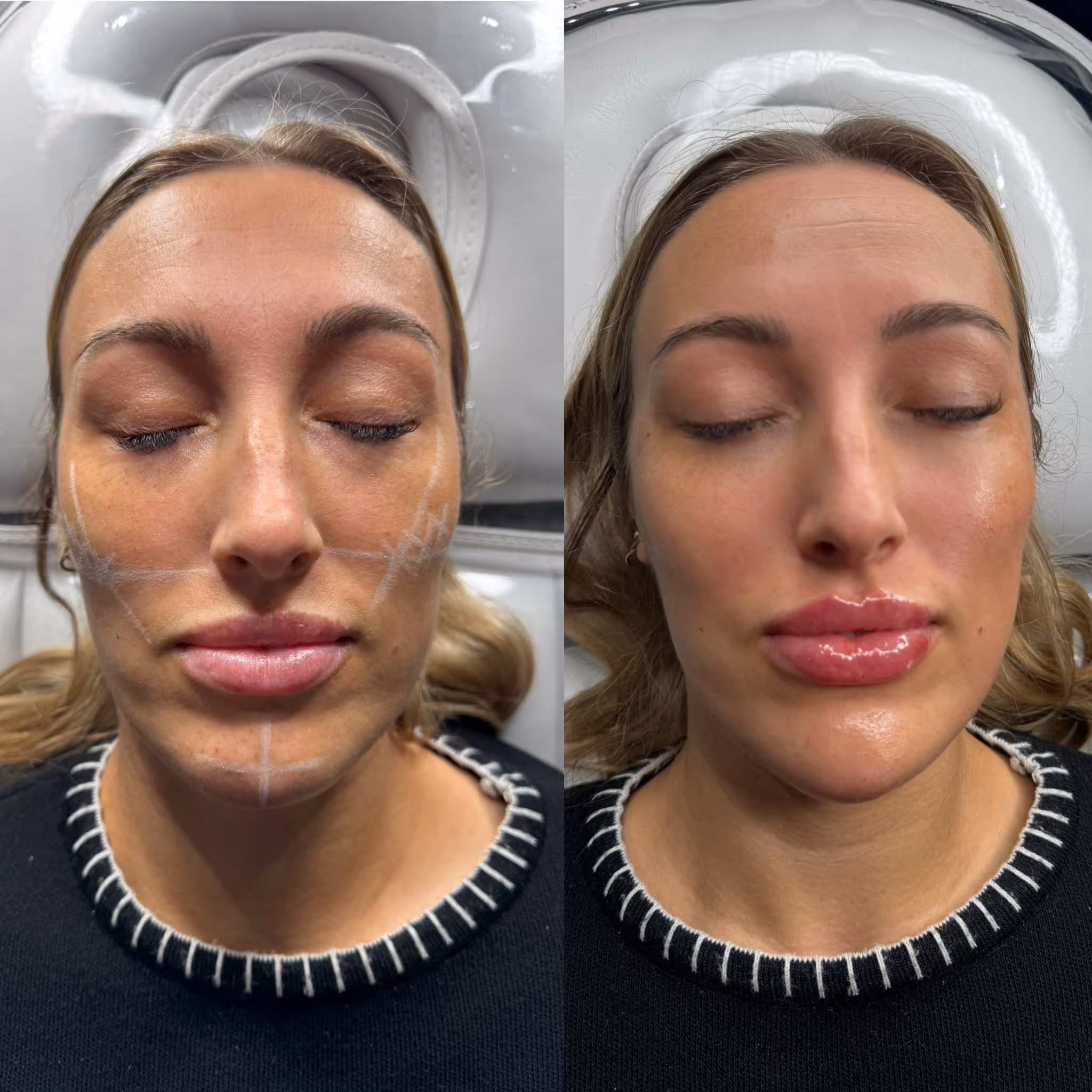 Before and after Botox results at CA Clinic Dubai