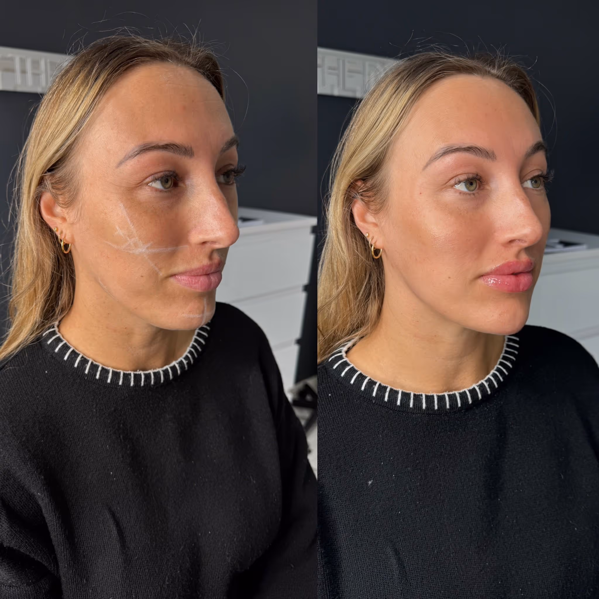 Before and after Botox results at CA Clinic Dubai