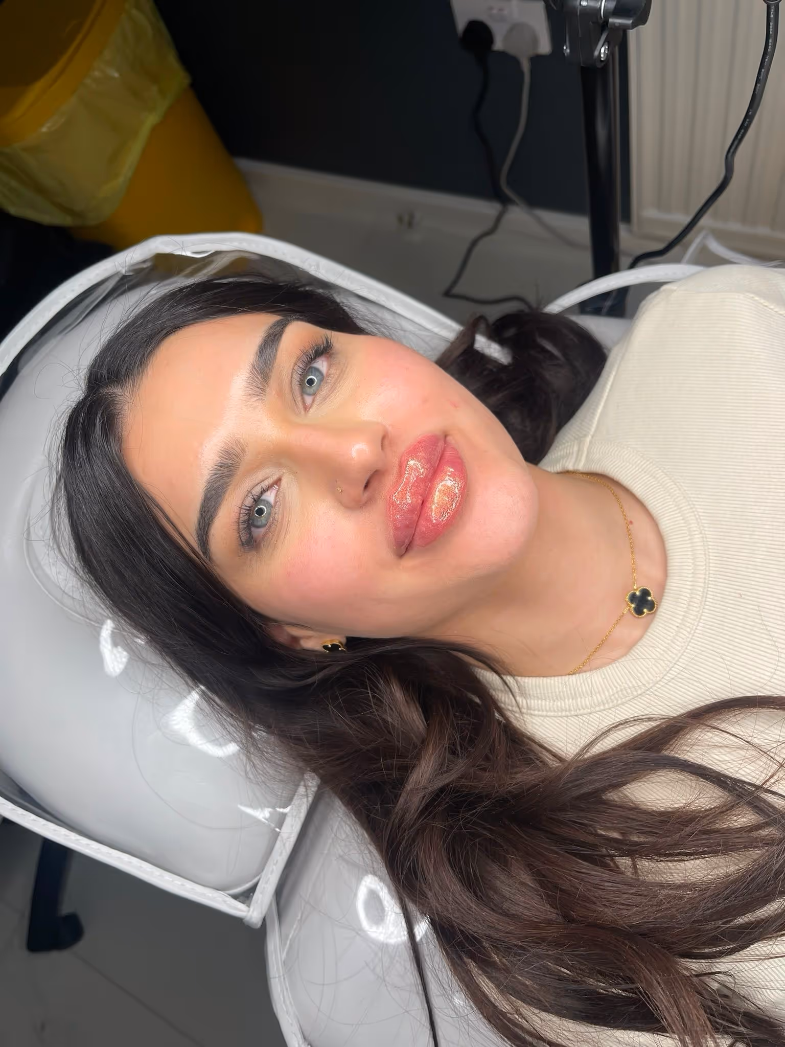 Dermal filler treatment by Chanelle at CA Clinic Uae