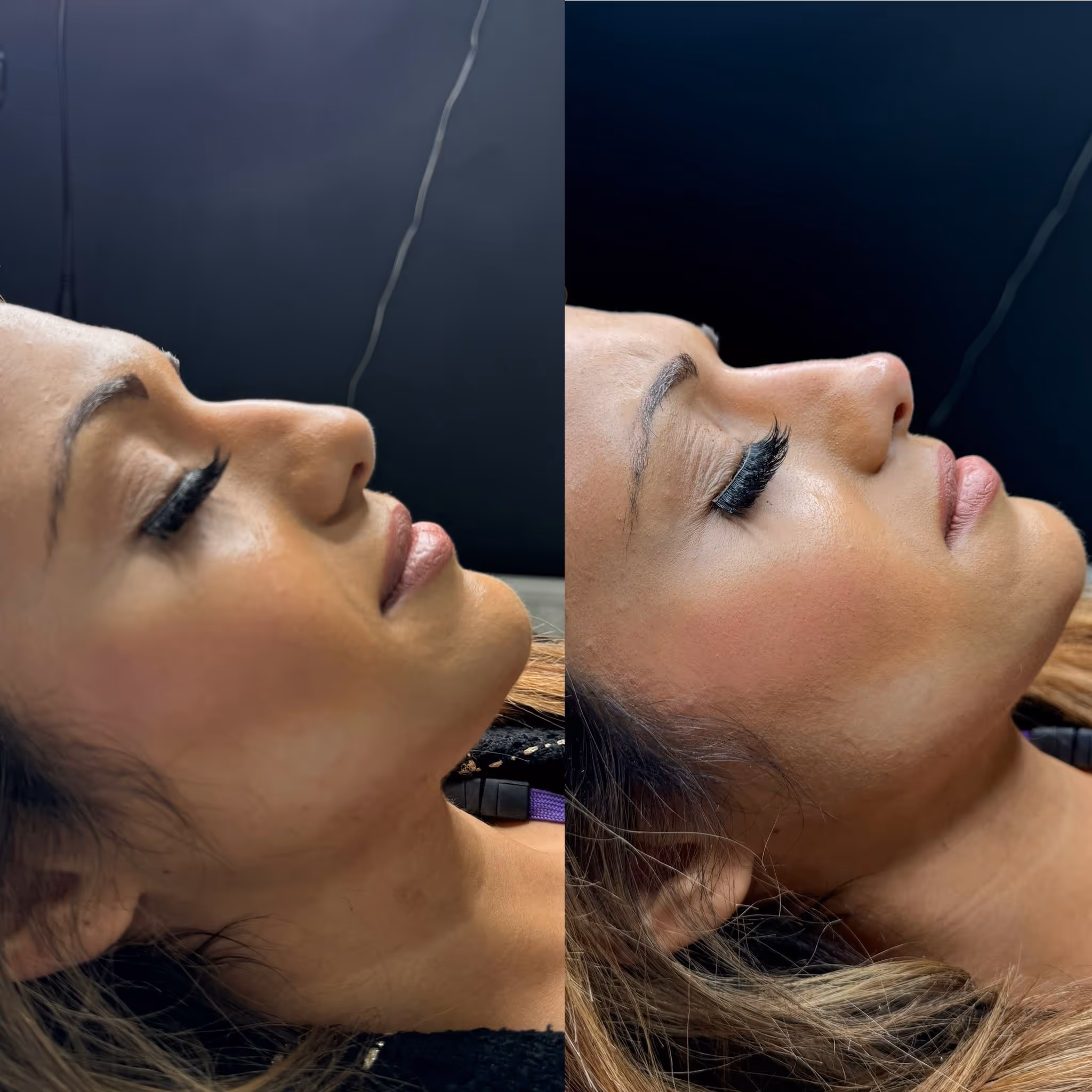 Before and after Botox results at CA Clinic Dubai