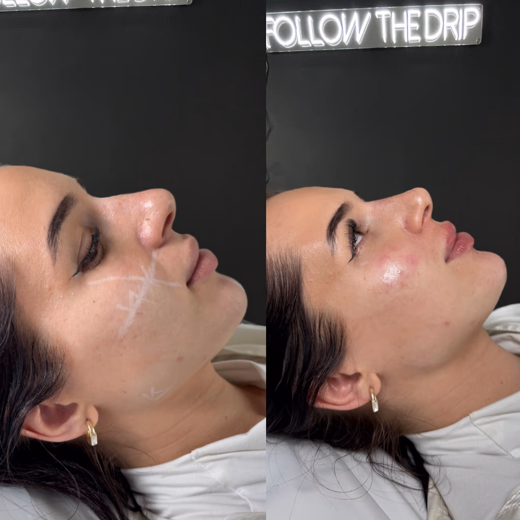 Before and after Botox results at CA Clinic Dubai