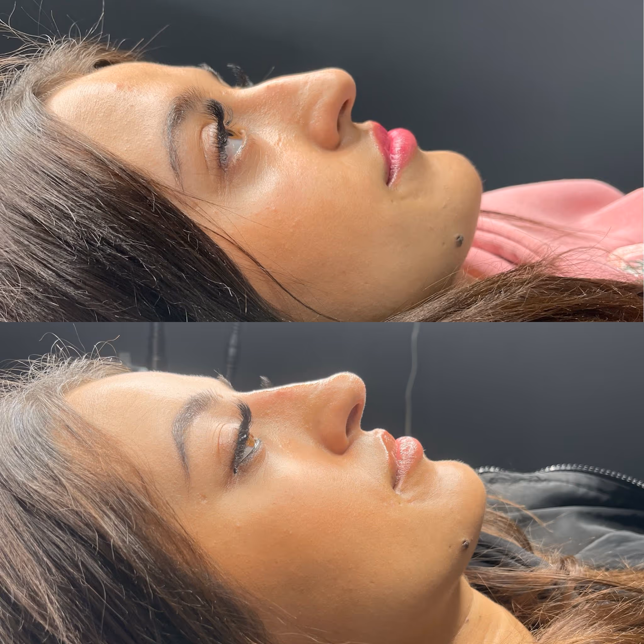 Before and after Botox results at CA Clinic Dubai