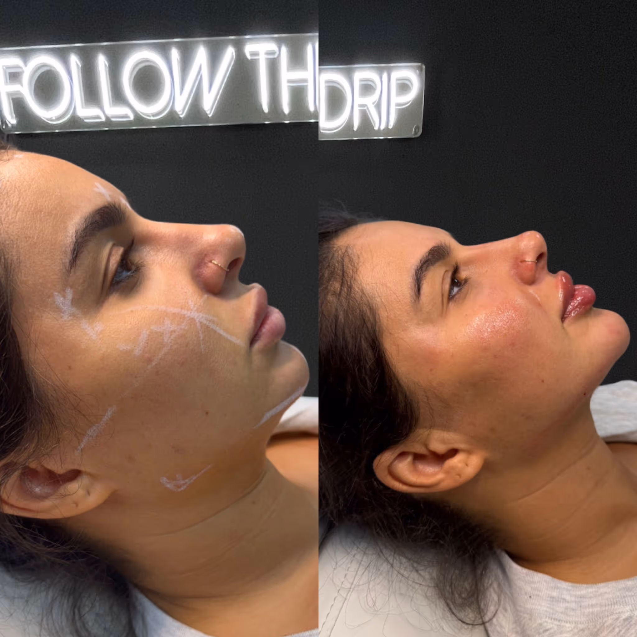 Botox treatment by Chanelle at CA Clinic Uae