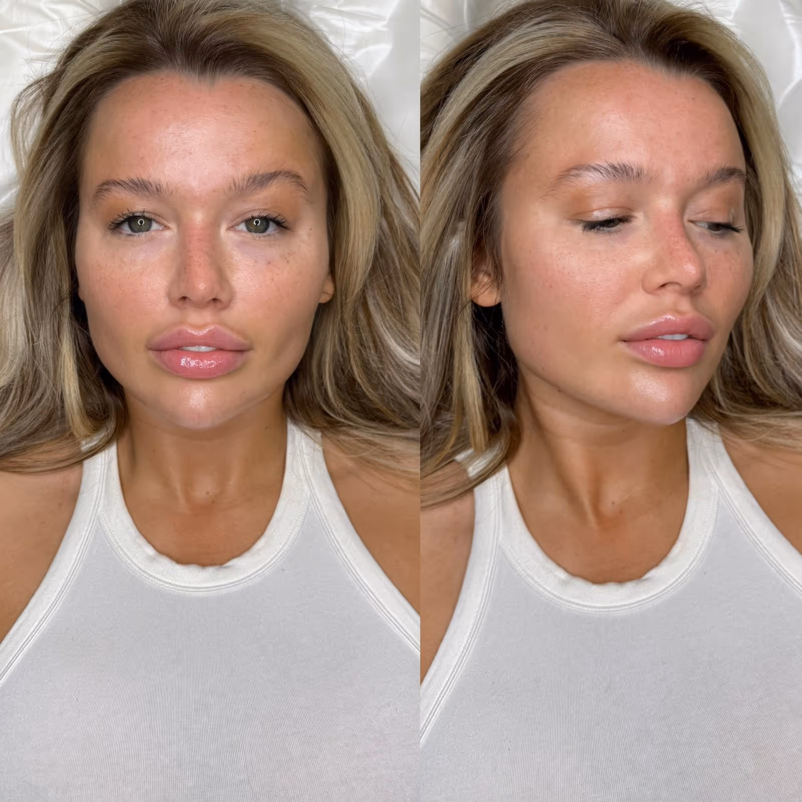 Before and after Botox results at CA Clinic Dubai
