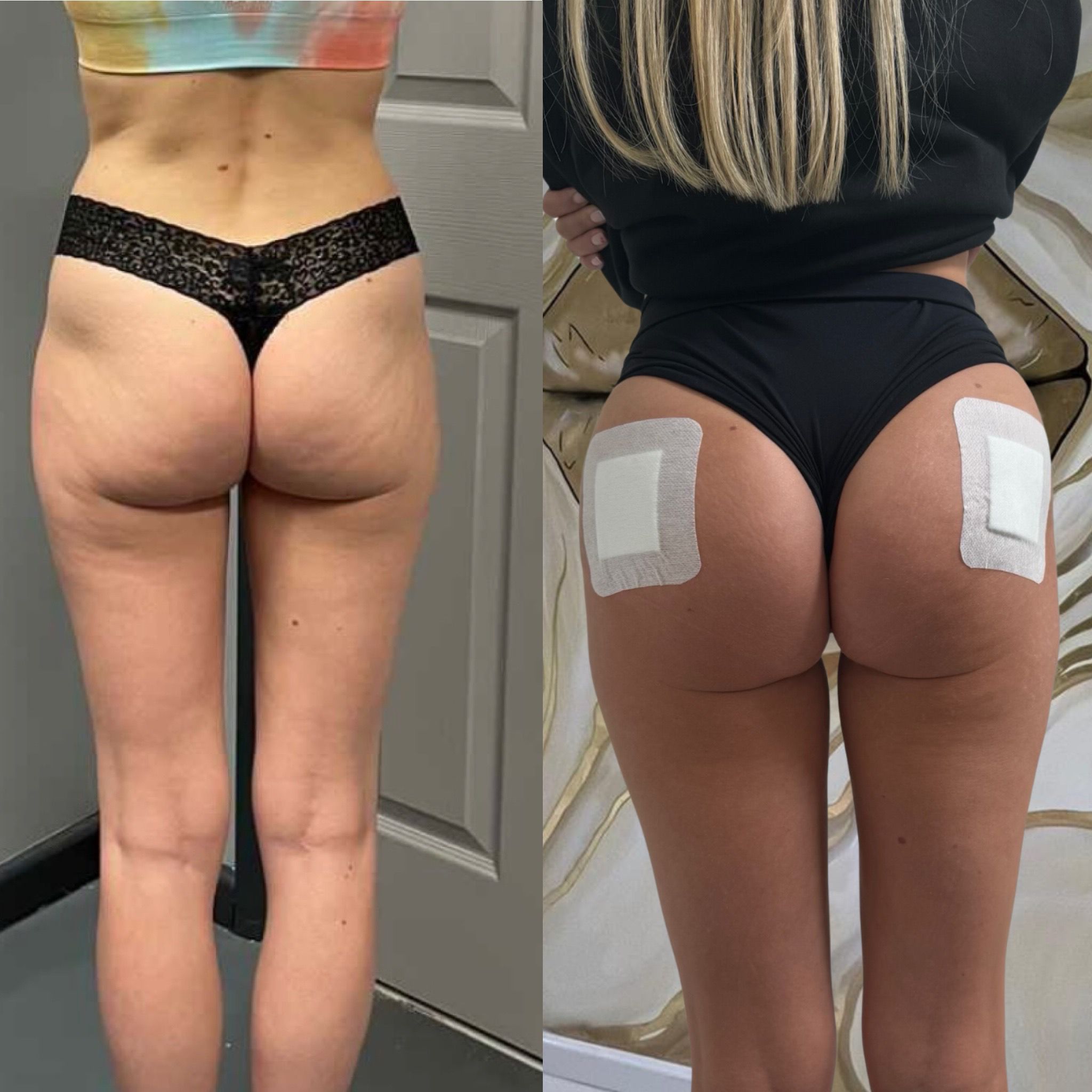 Buttock and hip filler treatment by Chanelle at CA Clinic Uae