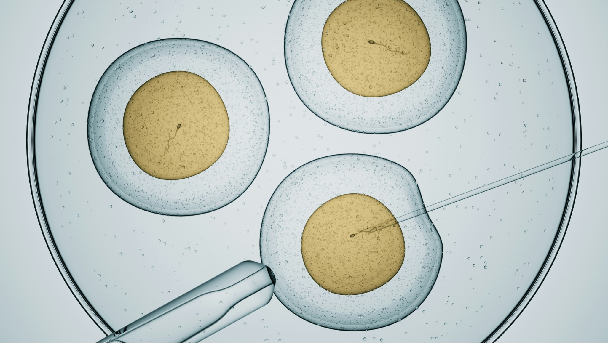 Illustration of intracytoplasmic sperm injection, with a sperm cell being injected directly into an egg under laboratory conditions.
