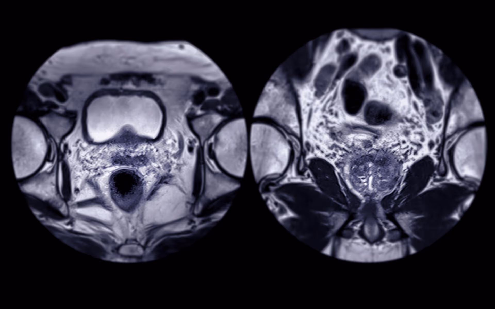 The Role of Advanced Imaging in Prostate Cancer Treatment