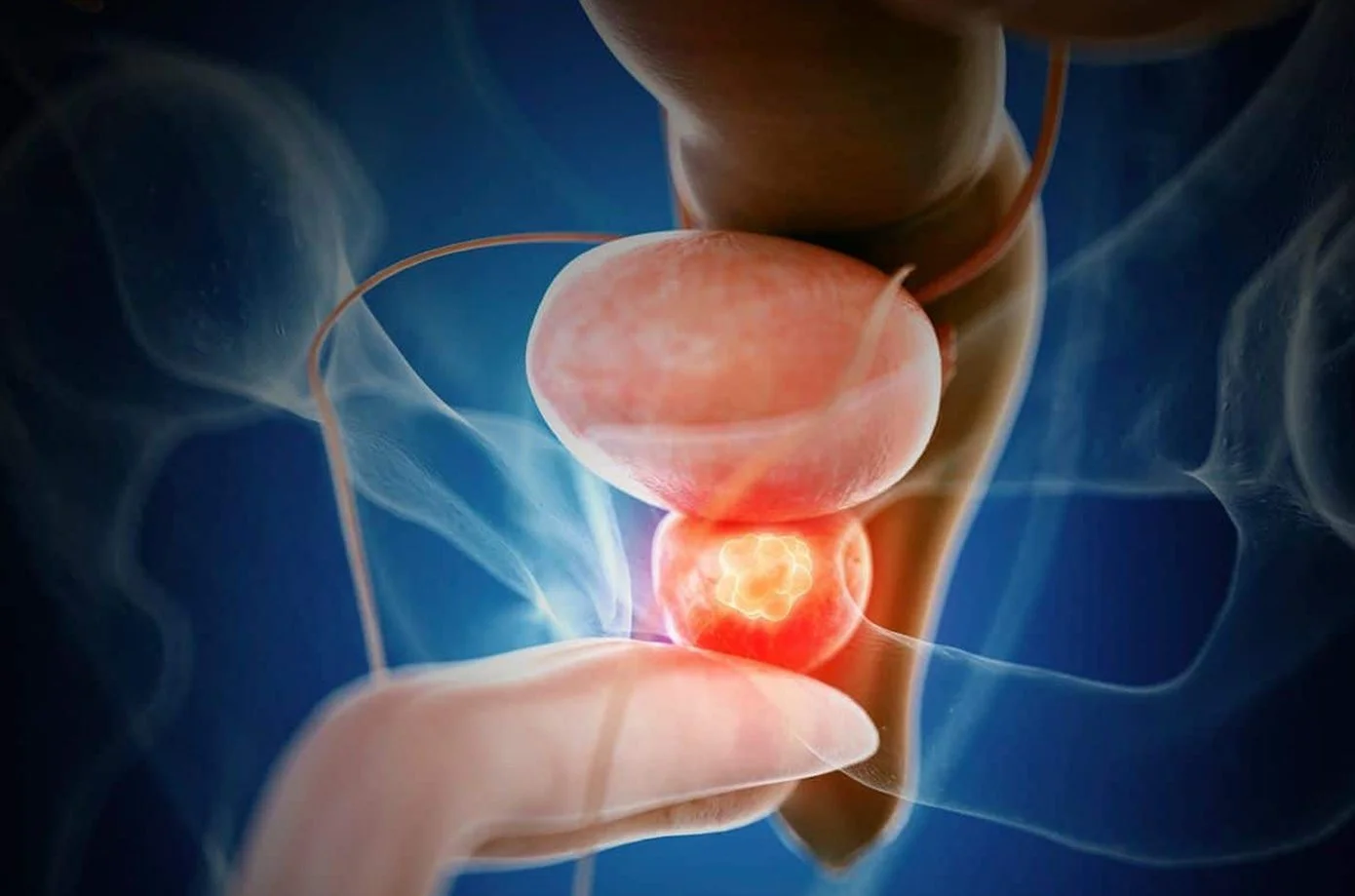 Prostate Cancer: know your risks