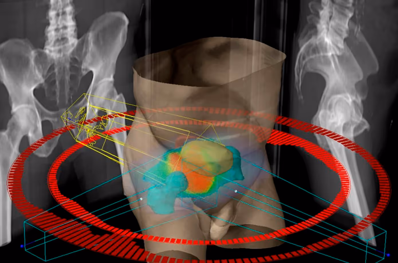 What is localized prostate cancer?
