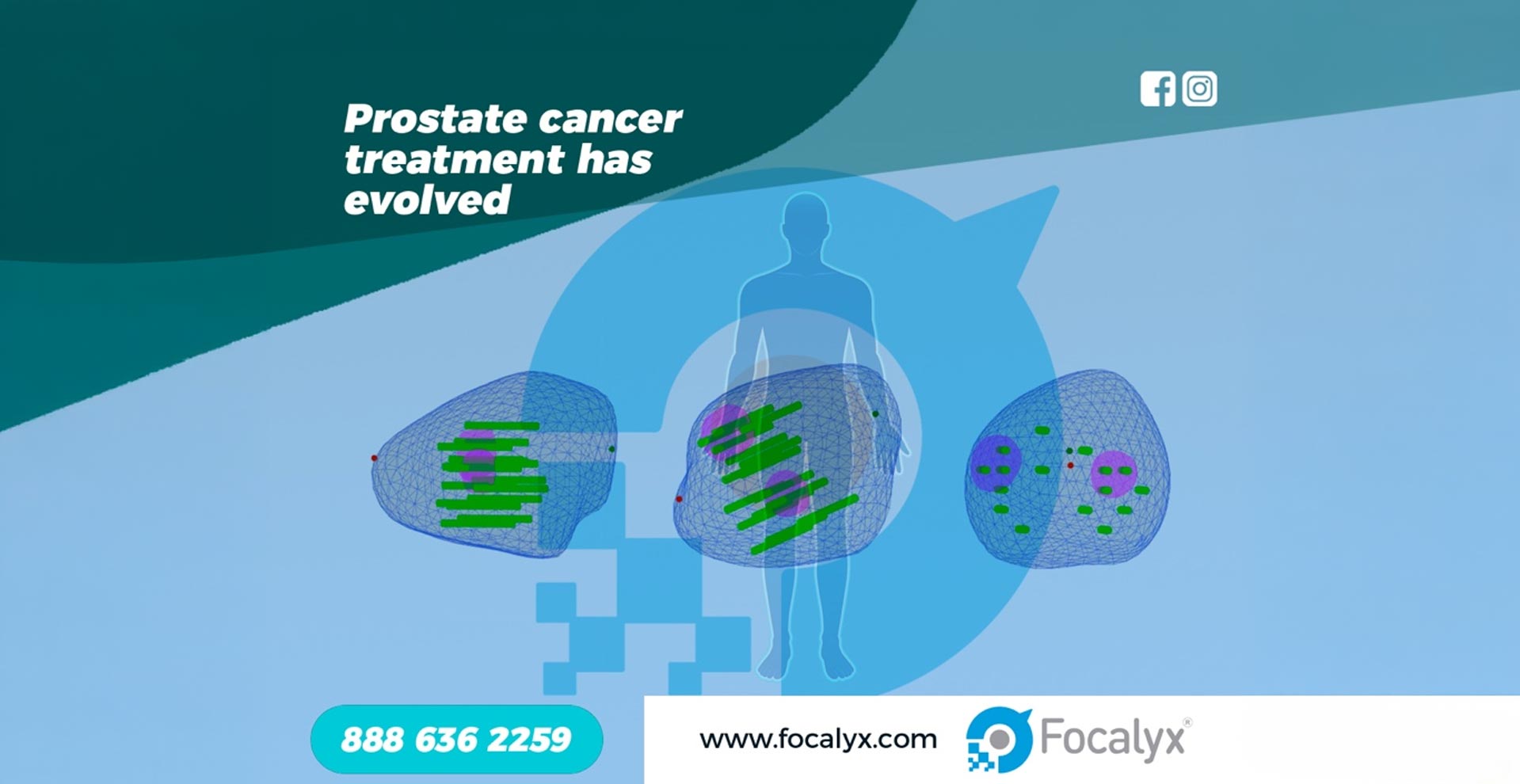 Prostate Cancer Care: Precision Treatment for Quality of Life