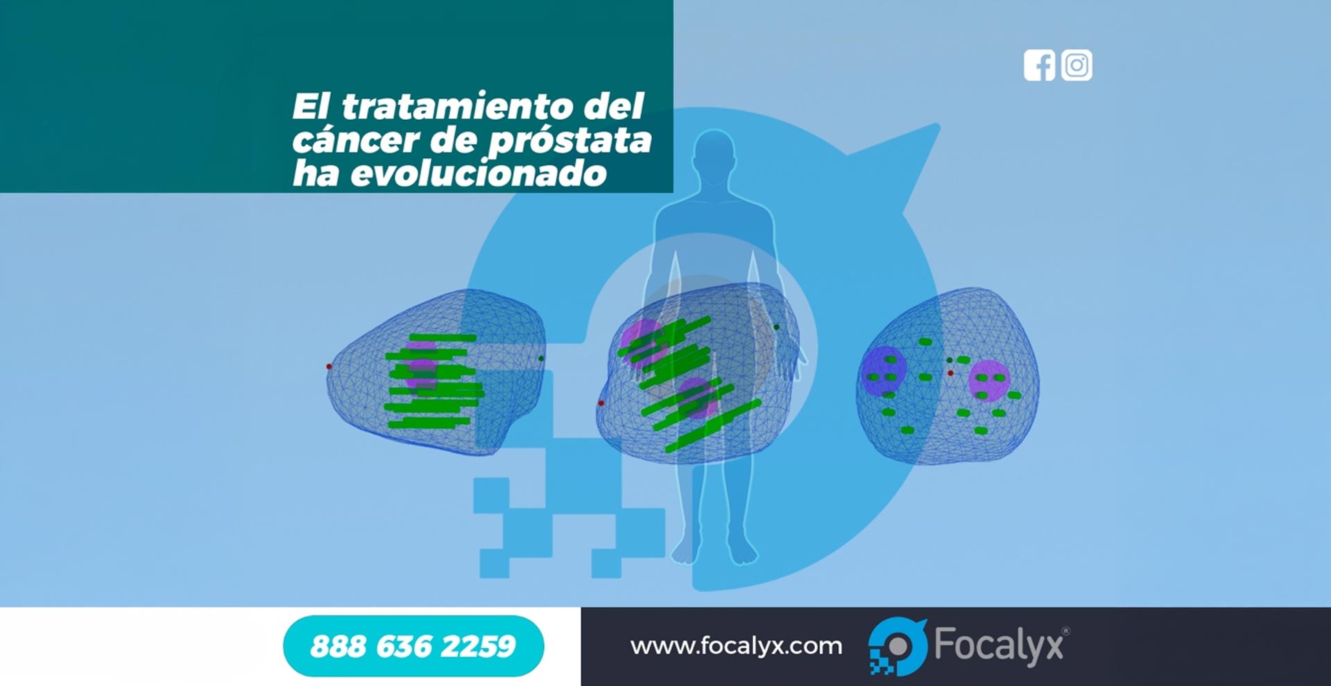 Tratamiento de Cáncer de Próstata: Preservando Calidad de Vida