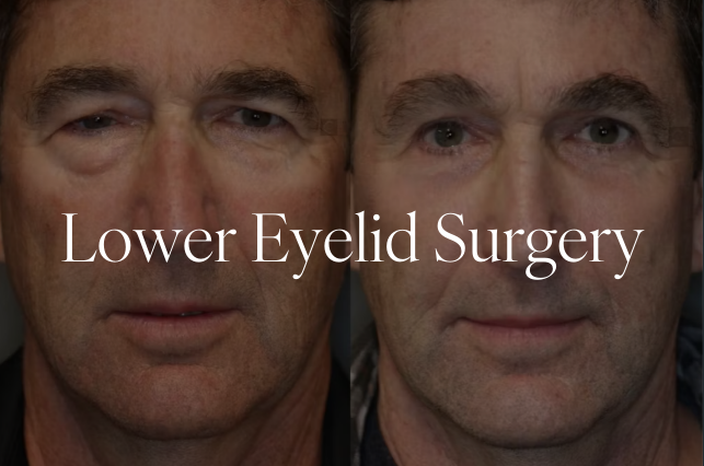 Laser Eyebag Removal Kl