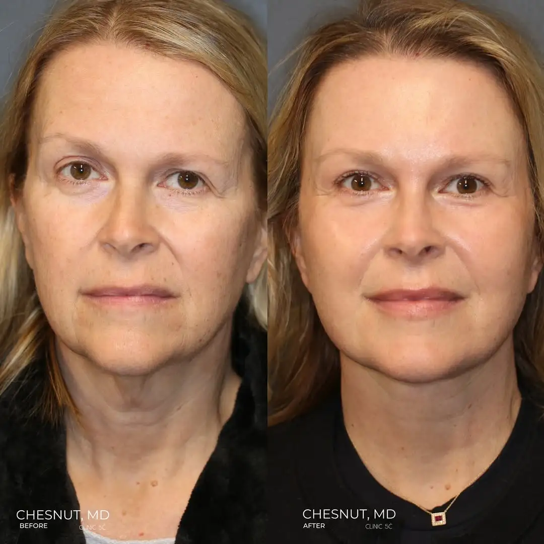 Before and After Image of Lisa - Kelm's Cosmetic Journey