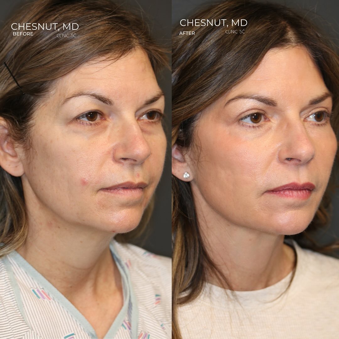 Before and After Image of Lisa - Kelm's Cosmetic Journey