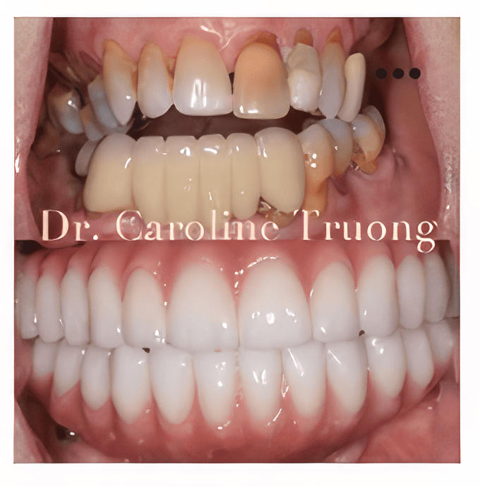 dental implant before and after photos - Jolie Smiles in Odessa, FL