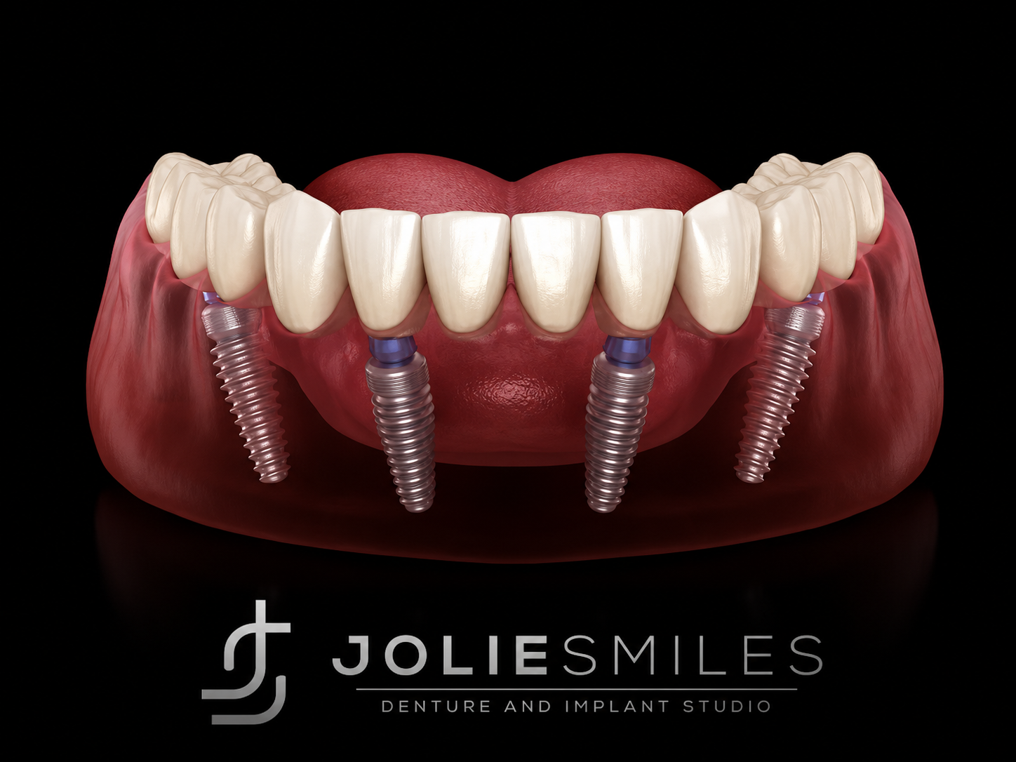 Full Jaw Implants