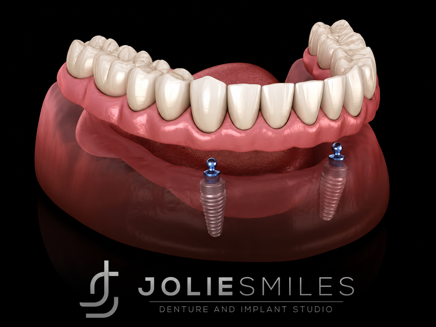 Snap-In Implant Denture