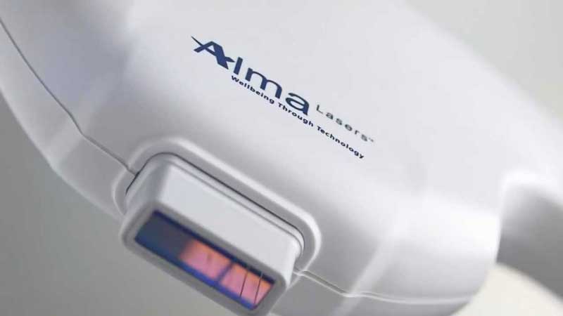 alma lasers in denver for laser hair removal