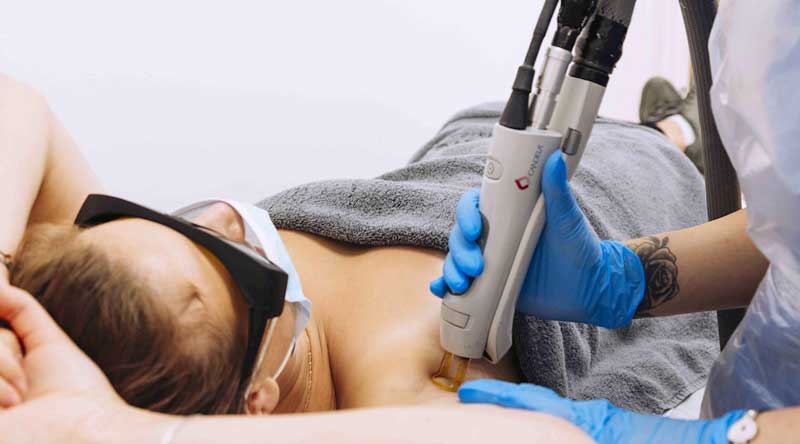 candela gentle max pro laser review