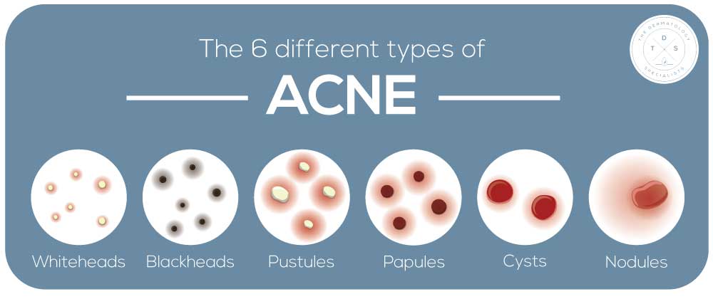 kinds of acne