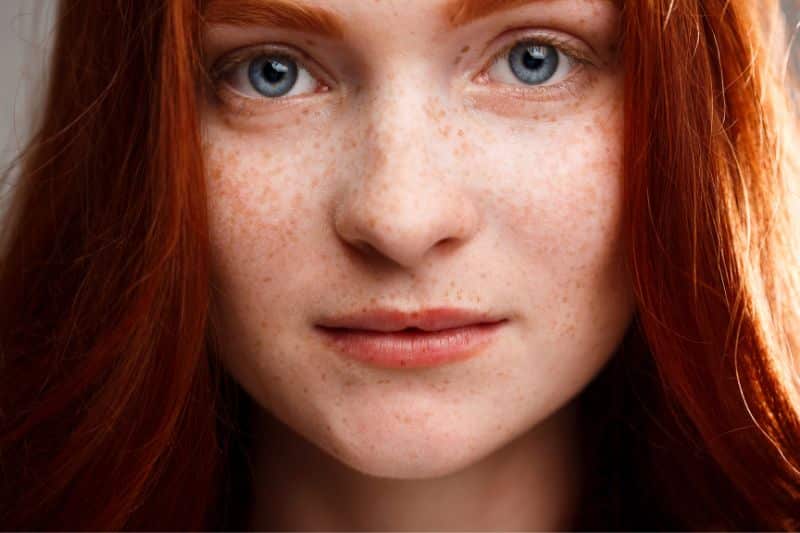 Guide for Vulgaris Acne