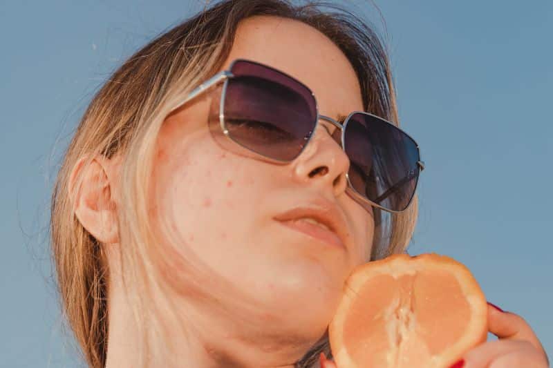 Detailed guide about cystic acne