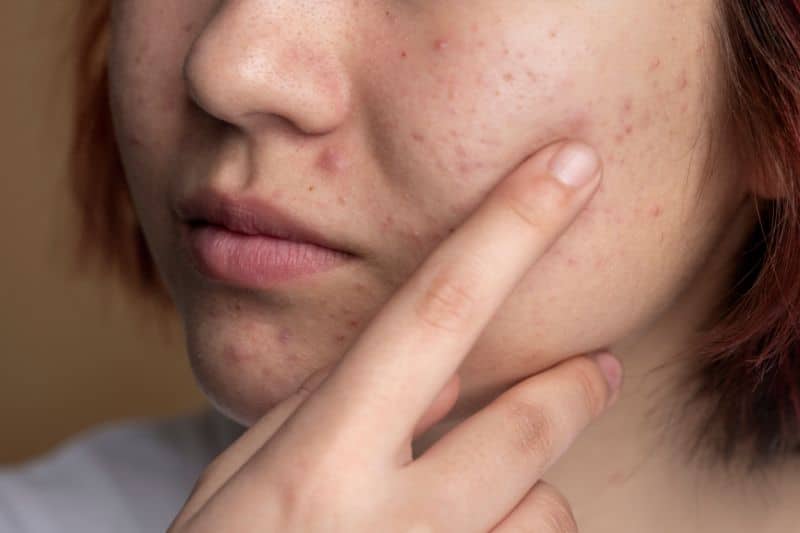 Guide about the nodular acne, it's treatment and preventive measures