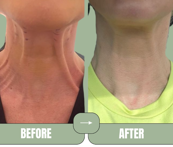 Neck Botox