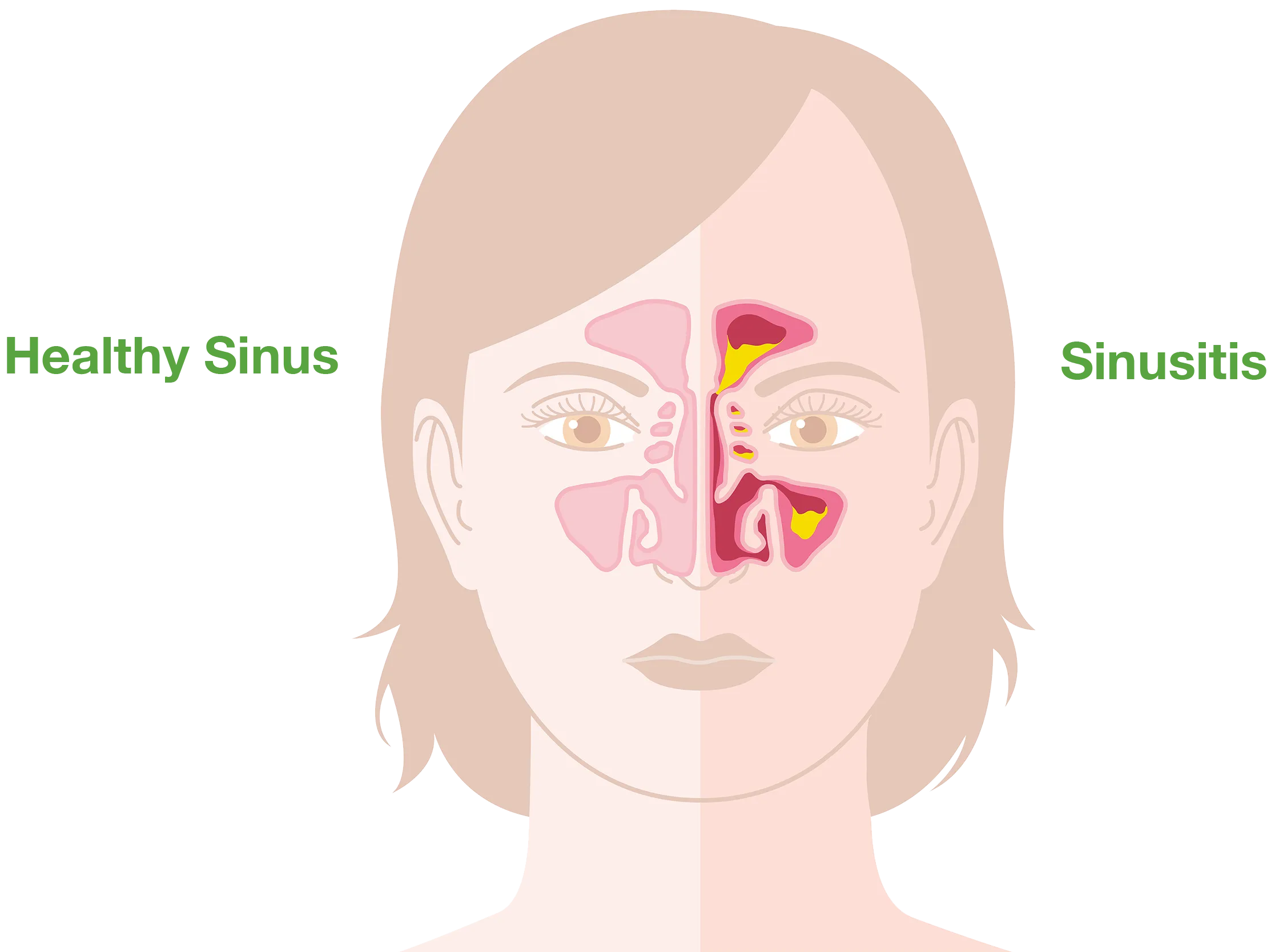 sinus infection symptoms