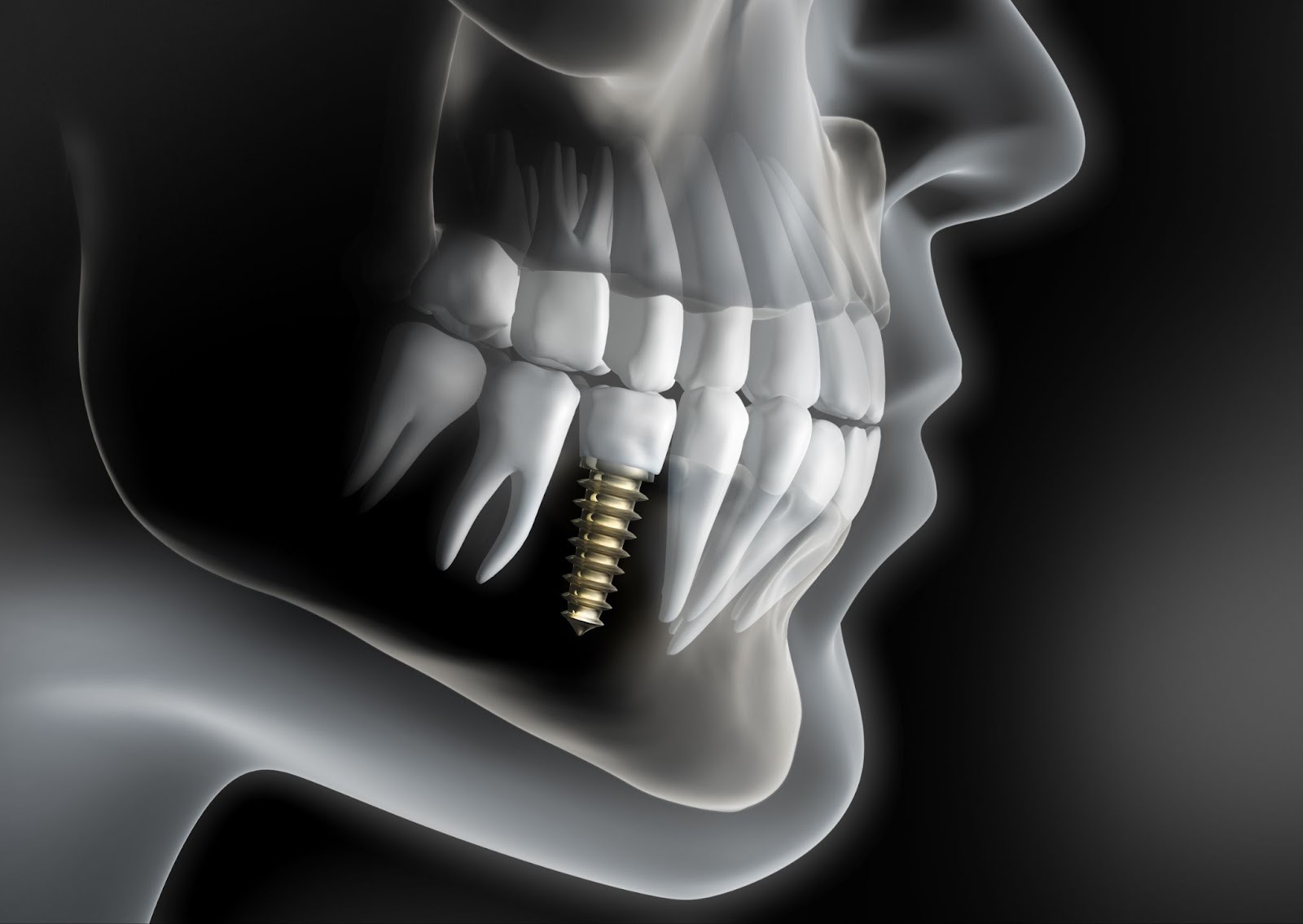 3D illustration of a dental implant placed in the lower jaw showing how implant treatment supports missing teeth