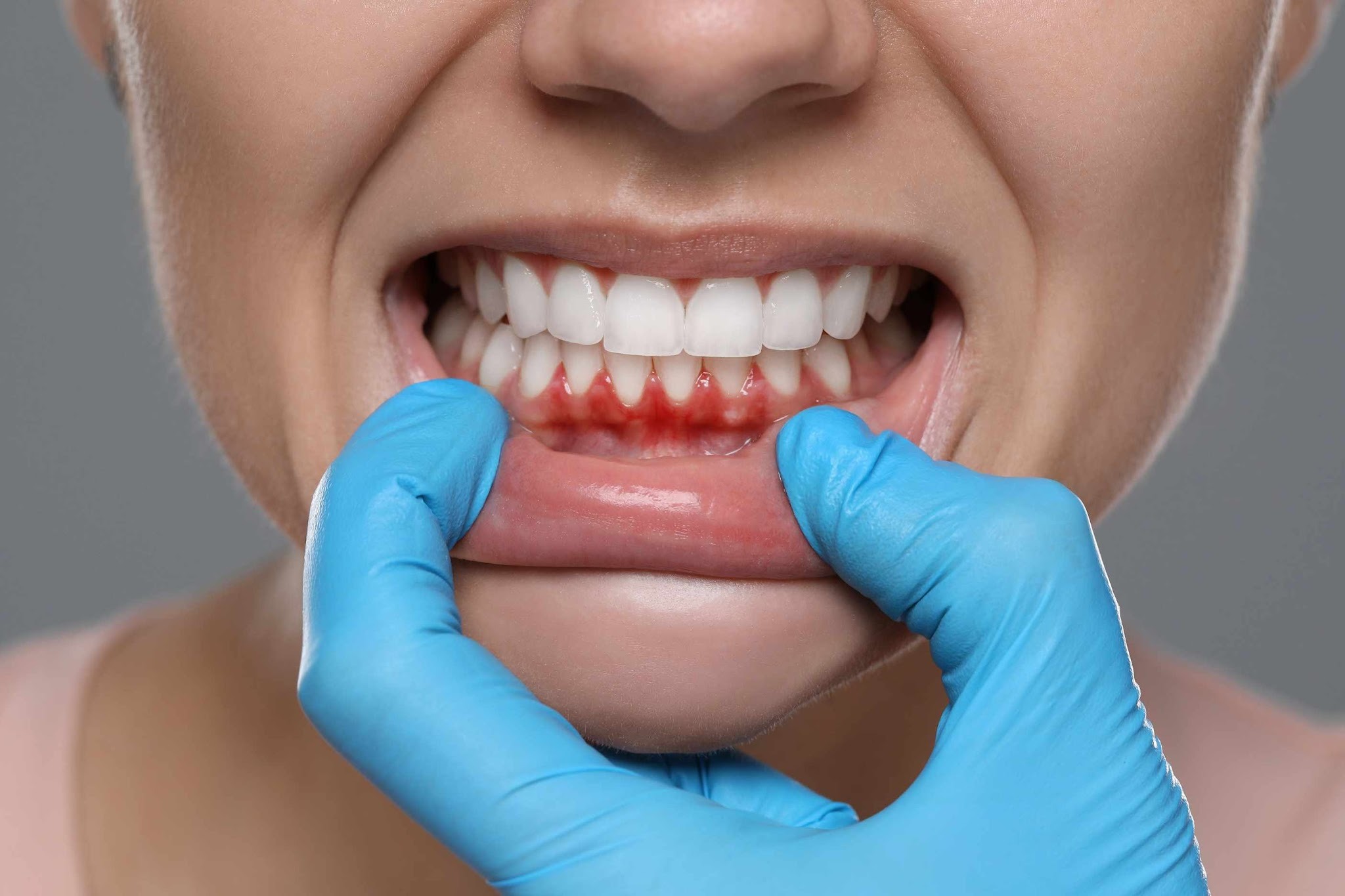 Bleeding gums during dental examination showing early signs of gum disease requiring treatment in Upminster
