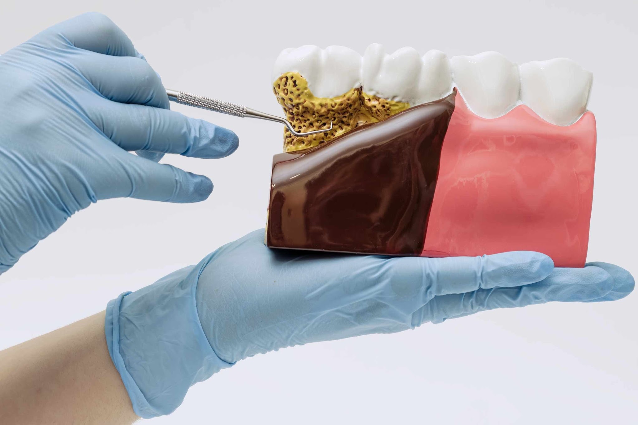 Dental model illustrating advanced periodontal disease affecting the gums and supporting bone