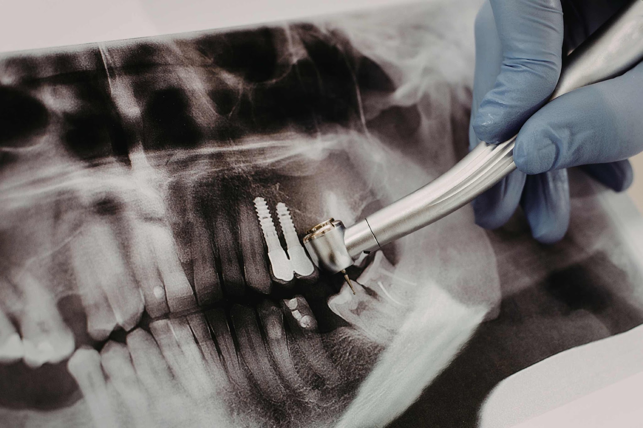 Dental implant shown on X-ray illustrating titanium implant placed within the jawbone to replace a missing tooth