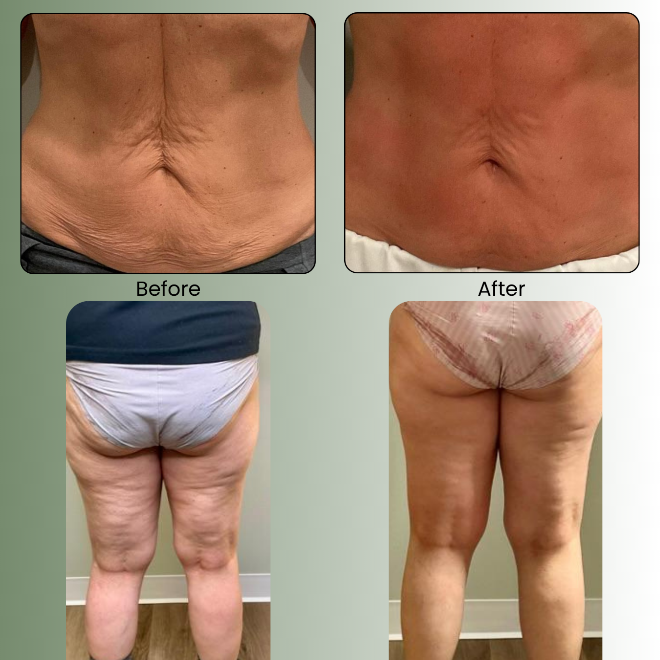 Body Contouring