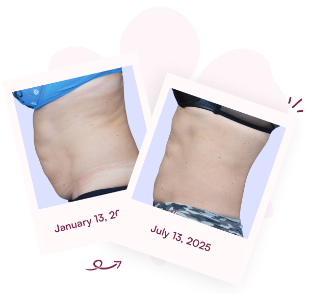 Before and after body transformation showing torso progress between EmSculpt Treatments