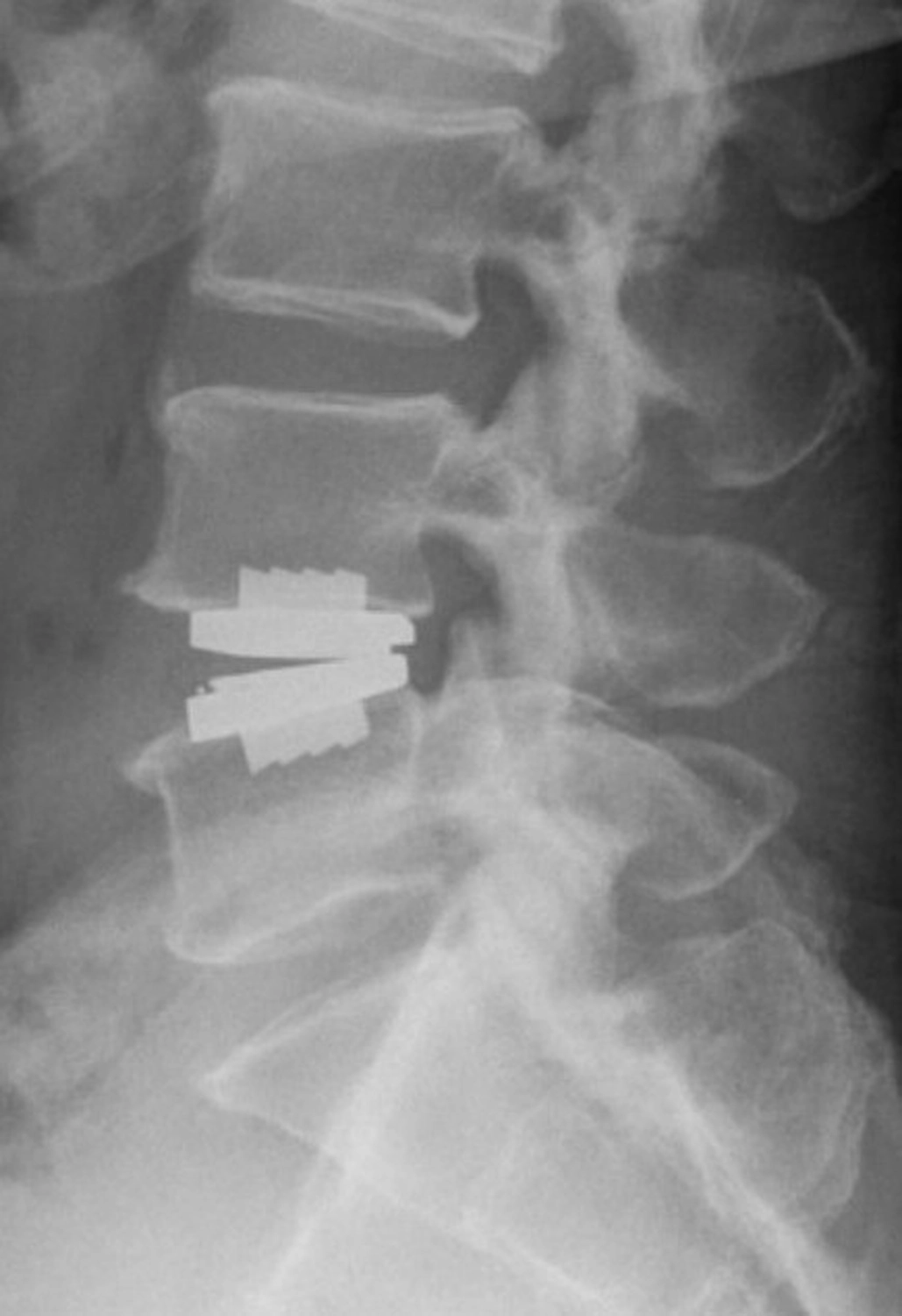 STENUM – Fachklinik für Orthopädie – Röntgenaufnahme der Wirbelsäule mit Implantaten zur Wirbelsäulenfusion