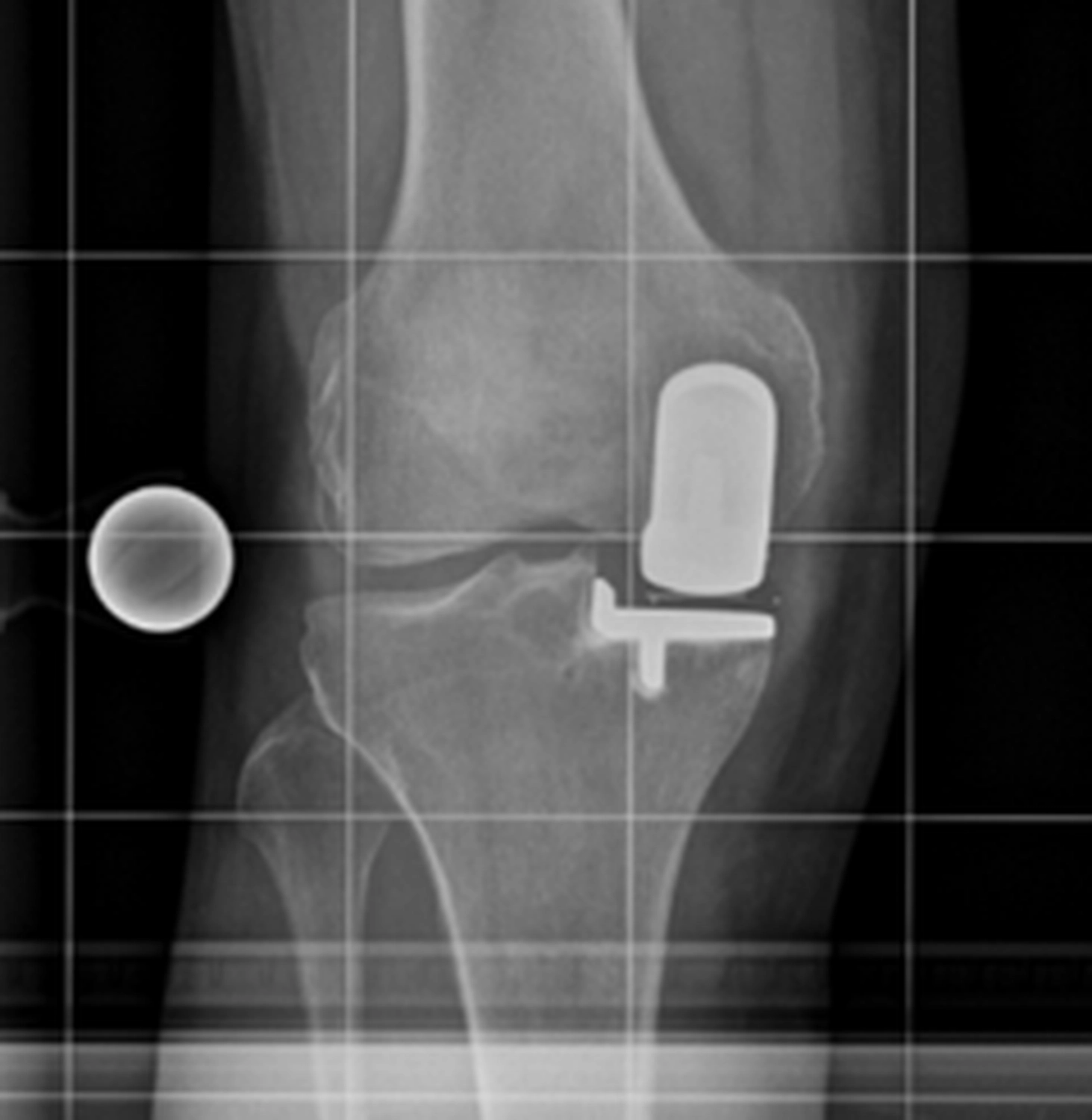 STENUM – Specialist Clinic for Orthopedics – X-ray showing Partial prosthesis