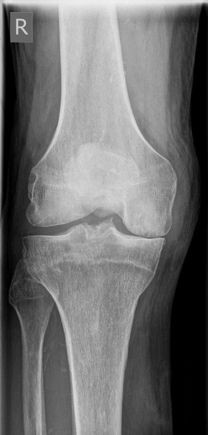 STENUM – Fachklinik für Orthopädie – Röntgenaufnahme mit Teilprothese