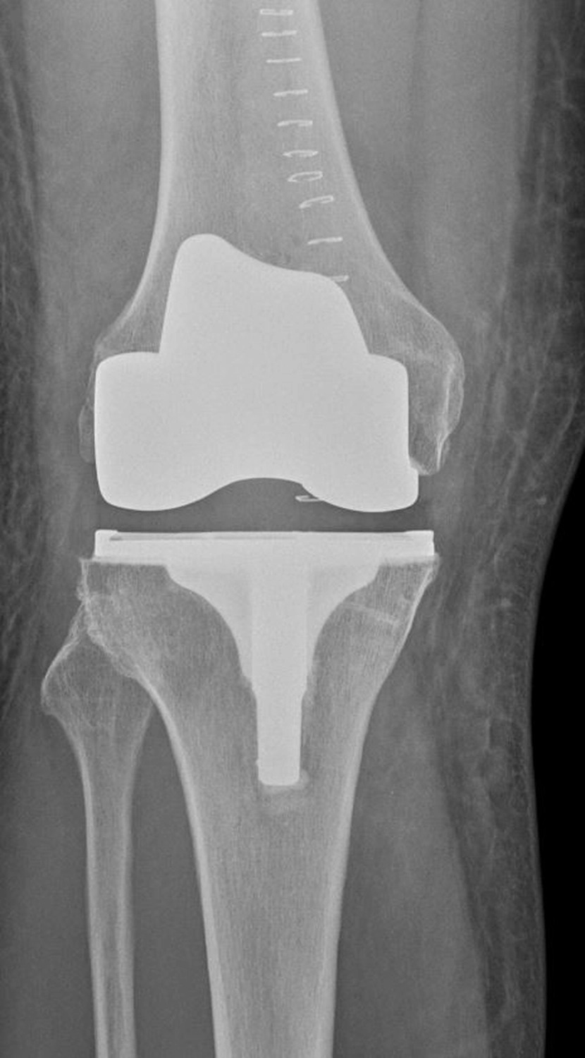 STENUM – Fachklinik für Orthopädie – Röntgenaufnahme mit Totalendoprothese