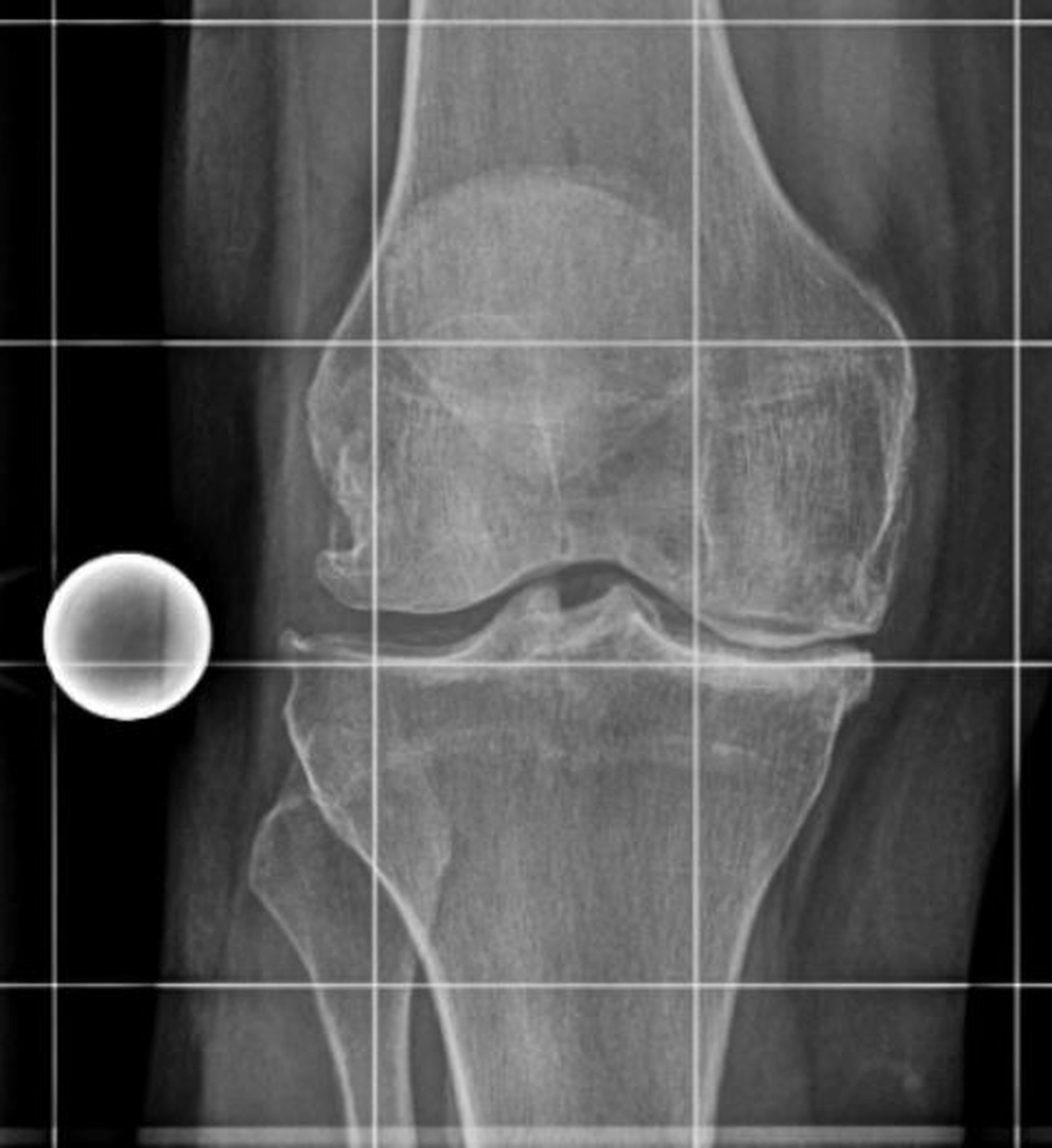 STENUM – Fachklinik für Orthopädie – Röntgenaufnahme mit Totalendoprothese